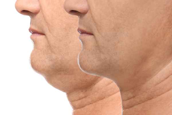 HIFU - Breakthrough in Anti - ageing 2 hifu results Maplehurst