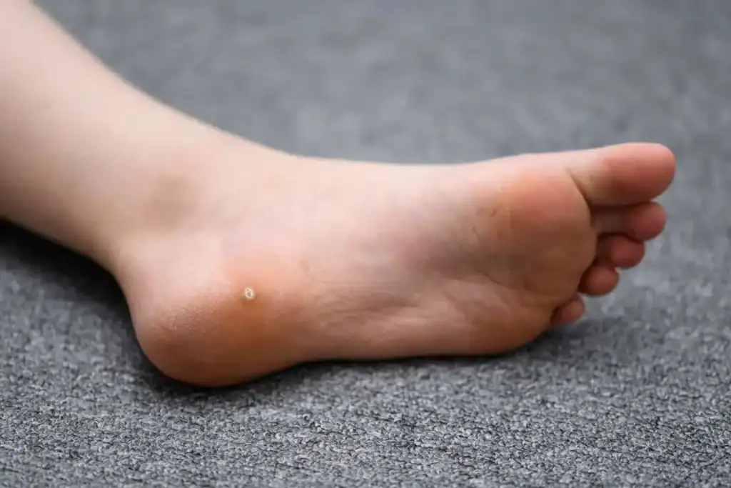 Cryotherapy For Warts And Also Verrucas 2 Image of verruca on the bottom of the foot that able to be treated with Cryotherapy Maplehurst