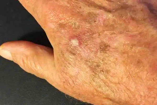Image of Actinic keratoses Maplehurst on a person hand